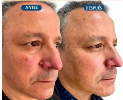 TagRecede™ - Elimina verrugas sin dolor y seguro + ENVIO GRATIS