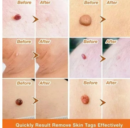 TagRecede™ - Elimina verrugas sin dolor y seguro + ENVIO GRATIS