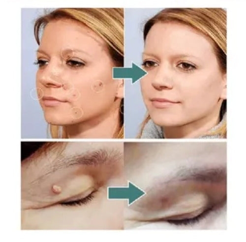TagRecede™ - Elimina verrugas sin dolor y seguro + ENVIO GRATIS